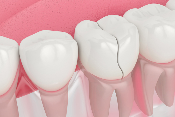 Dental crown procedure illustration showing tooth restoration on pink background with gum model.